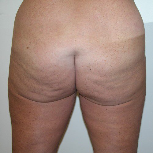 Abdominoplasty 8 Before Photo