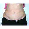 Abdominoplasty 37B After Photo Thumbnail