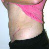 Abdominoplasty 37B After Photo Thumbnail