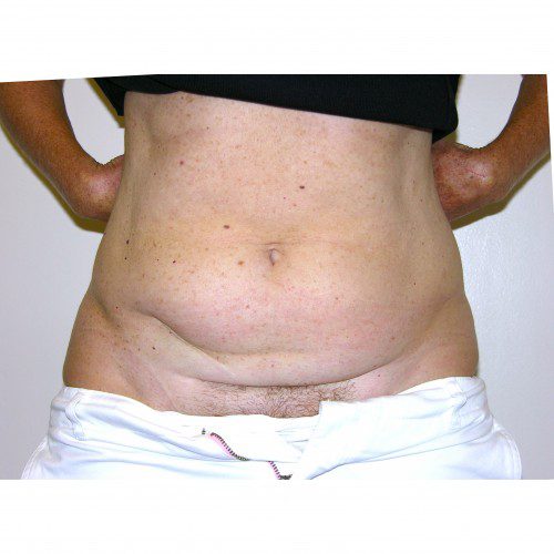 Abdominoplasty 37B Before Photo 