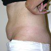 Abdominoplasty 37B Before Photo Thumbnail