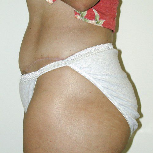 Abdominoplasty 38 After Photo