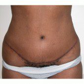 Abdominoplasty 9