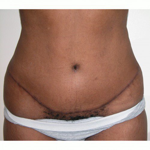 Abdominoplasty 9 After Photo 