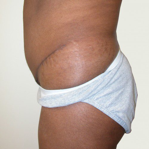 Abdominoplasty 9 After Photo