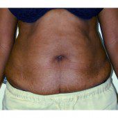 Abdominoplasty 9