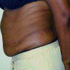 Abdominoplasty 9 Before Photo Thumbnail