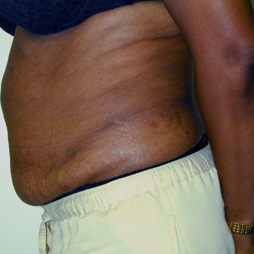 Abdominoplasty 9 Before Photo