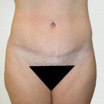 Abdominoplasty 10 After Photo - 7