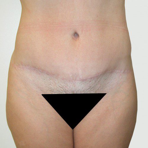 Abdominoplasty 10 After Photo 