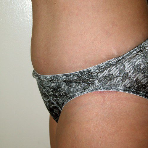 Abdominoplasty 10 After Photo