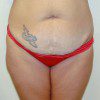 Abdominoplasty 10 Before Photo Thumbnail