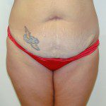 Abdominoplasty 10 Before Photo - 7