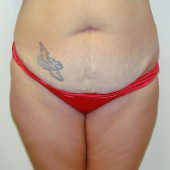 Abdominoplasty 10