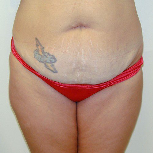 Abdominoplasty 10 Before Photo 