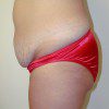 Abdominoplasty 10 Before Photo Thumbnail