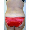 Abdominoplasty 10 Before Photo Thumbnail