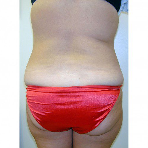 Abdominoplasty 10 Before Photo