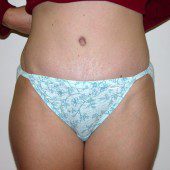 Abdominoplasty 4