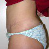 Abdominoplasty 4 After Photo Thumbnail