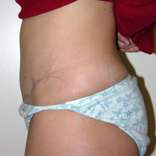 Abdominoplasty 4 After Photo