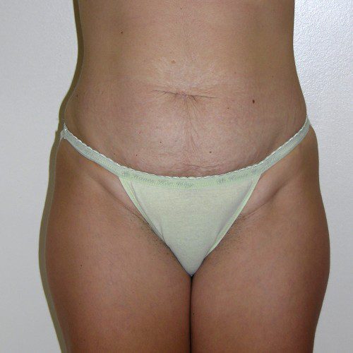 Abdominoplasty 4 Before Photo 