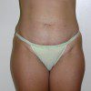 Abdominoplasty 4 Before Photo Thumbnail