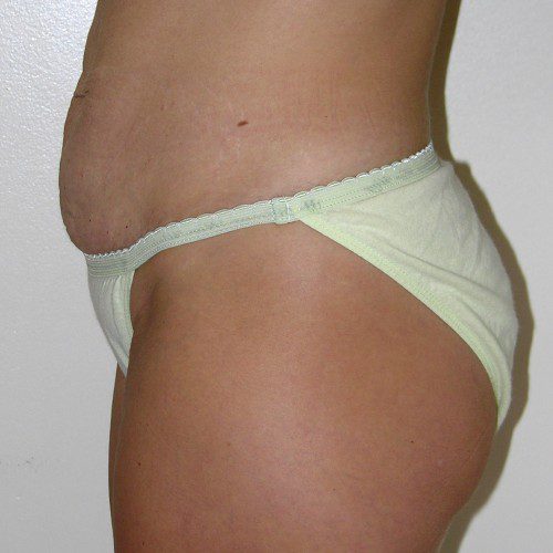 Abdominoplasty 4 Before Photo