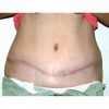 Abdominoplasty 11 After Photo Thumbnail