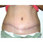 Abdominoplasty 11