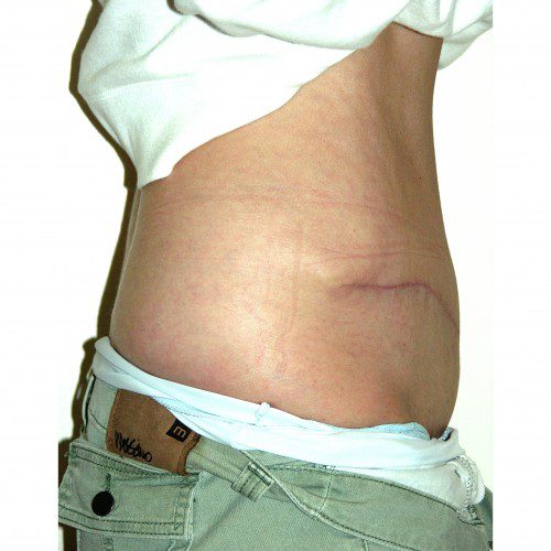 Abdominoplasty 11 After Photo