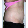 Abdominoplasty 11 Before Photo Thumbnail