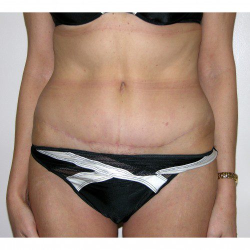 Abdominoplasty 12 After Photo