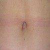 Abdominoplasty 12 After Photo Thumbnail