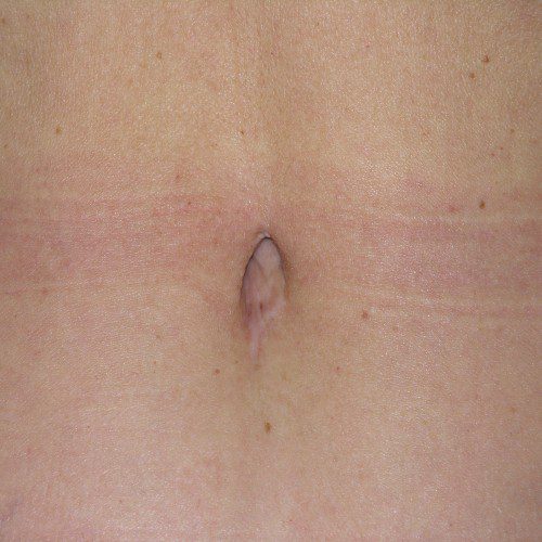 Abdominoplasty 12 After Photo