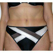 Abdominoplasty 12