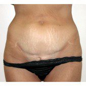 Abdominoplasty 12