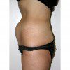 Abdominoplasty 12 Before Photo Thumbnail