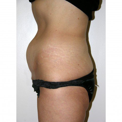 Abdominoplasty 12 Before Photo