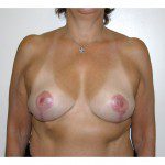 Breast Asymmetry  8 After Photo - 2