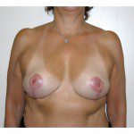 Breast Asymmetry  8 After Photo - 1