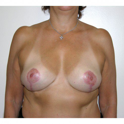 Breast Asymmetry 8 After Photo 