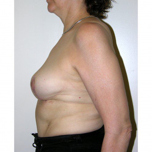 Breast Asymmetry 8 After Photo