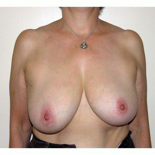 Breast Asymmetry 8 Before Photo 