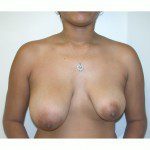 Breast Asymmetry  9 Before Photo - 1