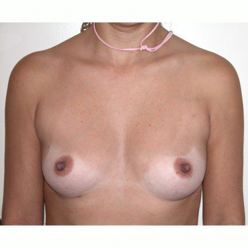 Breast Augmentation 33 Before Photo 