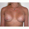 Breast Augmentation 32 After Photo Thumbnail
