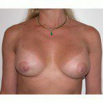 Breast Augmentation 32 After Photo - 10