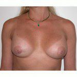 Breast Augmentation 32 After Photo - 5