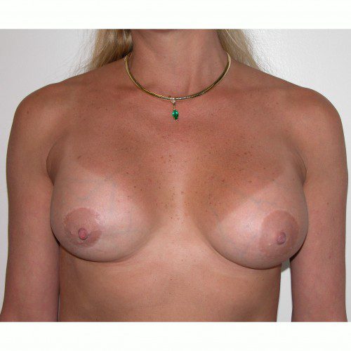 Breast Augmentation 32 After Photo 